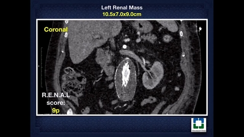 Thumbnail for entry Managing Stented Renal Arteries during Robotic-Assisted Partial Nephrectomy