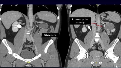 Thumbnail for entry Robotic Salvage Pyeloplasty with Buccal Mucosal Onlay Graft A Simplified Technique