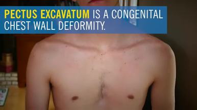 Pectus Excavatum: Symptoms, Tests, Management And Treatment