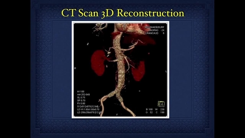 Thumbnail for entry Managing Stented Renal Arteries during Robotic-Assisted Partial Nephrectomy