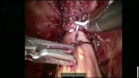 Thumbnail for entry Robotic-Assisted Radical Cystectomy with Intracorporeal Neobladder Formation