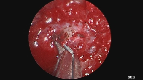 Thumbnail for entry Transsphenoidal Tumor Resection