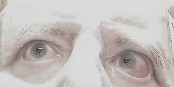 One and a Half Syndrome (Anderthalb Syndrom)