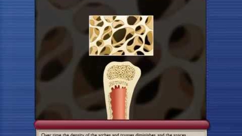 Thumbnail for What is Osteoporosis and How to prevent it