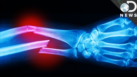 Thumbnail for How Much Force Does It Take To Break A Bone?