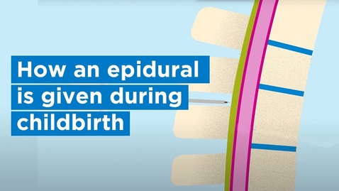 Thumbnail for How an epidural is given during childbirth