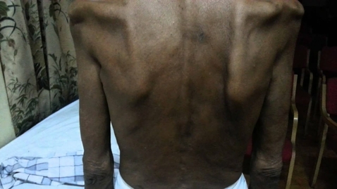Thumbnail for Fasciculations in motor neuron disease