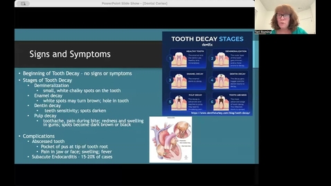 Thumbnail for Dental Caries