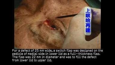 Video Gallery Plastic And Reconstructive Surgery Global Open