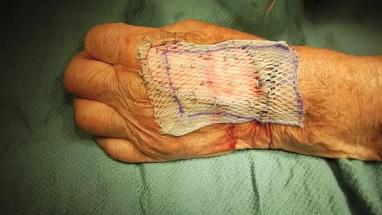 Surgical Wound Dressing Procedure Video Video Gallery Plastic And Reconstructive Surgery Global Open