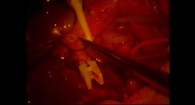 Video Gallery Plastic And Reconstructive Surgery Global Open