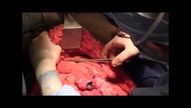 Video Gallery Plastic And Reconstructive Surgery Global Open