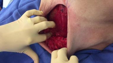 Surgical Wound Dressing Procedure Video Video Gallery Plastic And Reconstructive Surgery Global Open