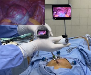 Video Gallery Obstetrics Gynecology The answer depends on the extent of the laceration and type of suture used. video gallery obstetrics gynecology