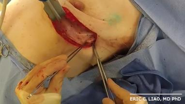 Video Gallery Plastic And Reconstructive Surgery Global Open