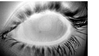 Cornea