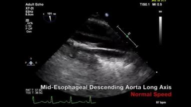 Video Gallery Anesthesia Analgesia