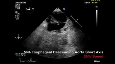 Video Gallery Anesthesia Analgesia