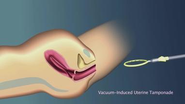 Video Gallery Obstetrics Gynecology