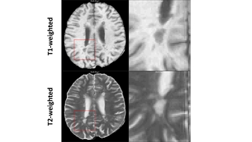 Effect of Evobrutinib on Slowly Expanding Lesion Volume in ...