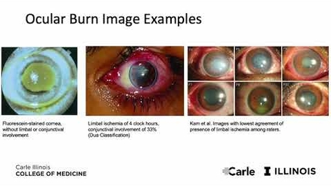 Thumbnail for entry Team 01: A Novel Approach to Automated Ocular Burn Image Classification and Analysis