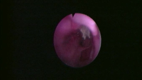 Thumbnail for Aspergillosis endoscopy