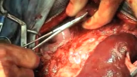 Thumbnail for Performing a liver biopsy using crush forceps