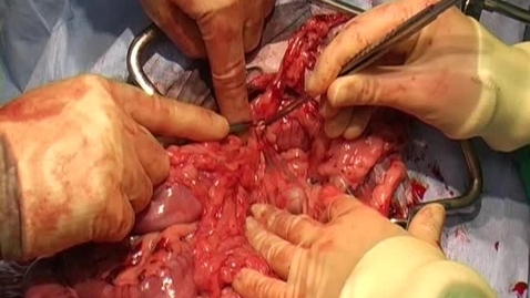 Thumbnail for entry Performing a pancreatic biopsy using the guillotine technique