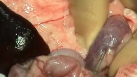 Thumbnail for Performing a renal biopsy
