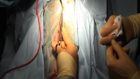 Thumbnail for Resecting falciform fat