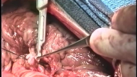 Thumbnail for Using the guillotine technique during surgical biopsies