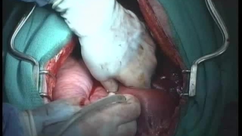 Thumbnail for entry Performing an incisional gastropexy