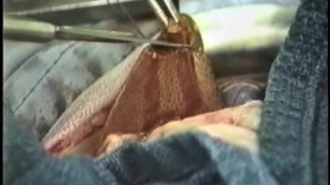 Thumbnail for Performing a liver biopsy using the guillotine technique