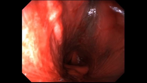 Thumbnail for entry Endoscopy of the gutteral pouch in the horse