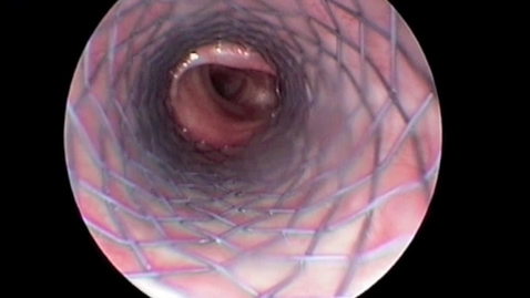 Thumbnail for Canine tracheal stenting to treat tracheal collapse