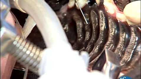 Thumbnail for Performing a palatine foramen block