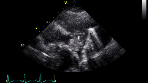 Thumbnail for entry Echocardiography: Clip 28