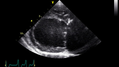 Thumbnail for entry Echocardiography: Clip 24