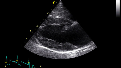 Thumbnail for entry Echocardiography: Clip 11