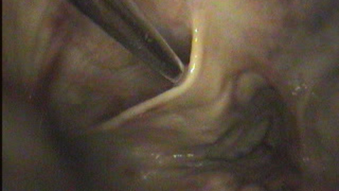 Thumbnail for URT endoscopy in the horse: Catheter entering the auditory tube