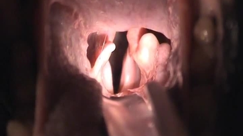 Thumbnail for entry Pre-operative laryngoscopy