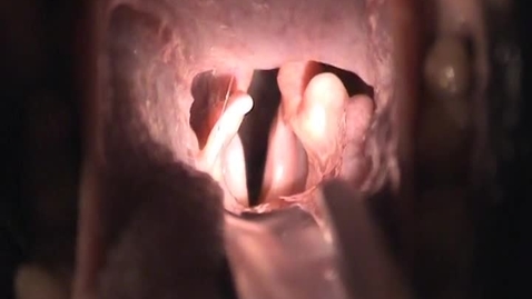 Thumbnail for Pre-operative laryngoscopy