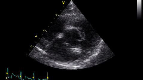 Thumbnail for entry Echocardiography: Clip 12