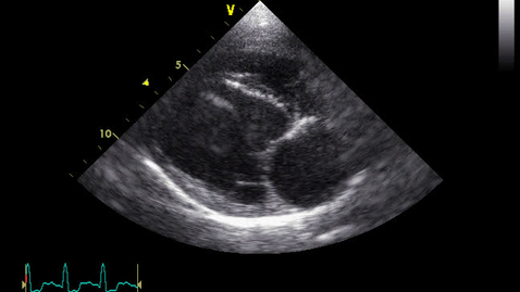 Thumbnail for entry Echocardiography: Clip 15