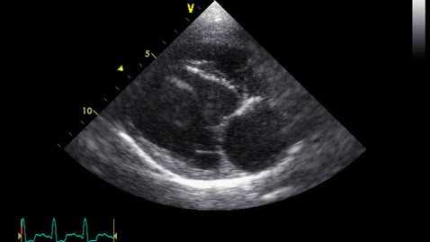 Thumbnail for Echocardiography: Clip 15