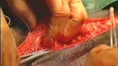 Thumbnail for entry Colic surgery in the horse