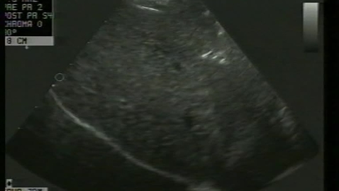 Thumbnail for Intestinal imaging: Clip 1