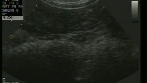 Thumbnail for Intestinal imaging:  Clip 2