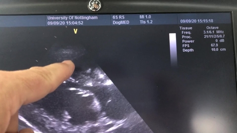 Thumbnail for entry Right parasternal view of the aortic valve