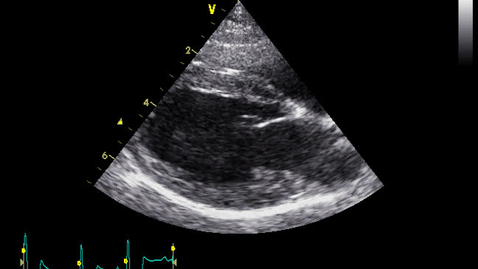 Thumbnail for entry Echocardiography: Clip 1